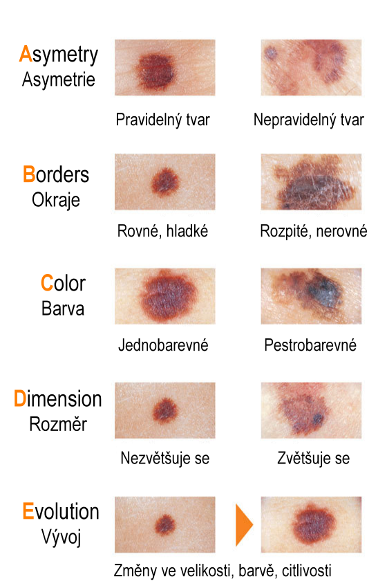 Samovyšetření mateřských znamének metodou ABCDE. Rozeznejte melanomy včas.